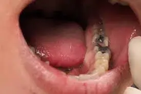 carillas, carillas, más barato, miami, kendall, centro de la ciudad, playa sur, fiu, más cercano a mí, dentista cerca de mí, dentista cerca de mi, mejor dentista miami, mejor dentista miami, pizza cerca de mí, chino cerca de mí, comida cerca de mí, corona dentista miami, dentista más barato miami, dentista de conducto radicular miami, conducto radicular más barato de miami